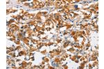 The image on the left is immunohistochemistry of paraffin-embedded Human thyroid cancer tissue using CSB-PA037884(DKK3 Antibody) at dilution 1/50, on the right is treated with fusion protein. (Original magnification: 