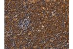 The image on the left is immunohistochemistry of paraffin-embedded Human Lymphoma tissue using CSB-PA037967(CDC34 Antibody) at dilution 1/50, on the right is treated with synthetic peptide. (Original magnification: 