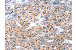 The image on the left is immunohistochemistry of paraffin-embedded Human liver cancer tissue using CSB-PA037992(GFRA3 Antibody) at dilution 1/20, on the right is treated with synthetic peptide. (Original magnification: 