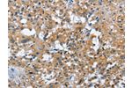 The image on the left is immunohistochemistry of paraffin-embedded Human thyroid cancer tissue using CSB-PA038092(ATF4 Antibody) at dilution 1/40, on the right is treated with fusion protein. (Original magnification: 