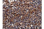 The image is immunohistochemistry of paraffin-embedded Human tonsil cancer tissue using CSB-PA038144(ADRB1 Antibody) at dilution 1/25. (Original magnification: 