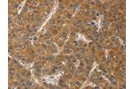 The image on the left is immunohistochemistry of paraffin-embedded Human liver cancer tissue using CSB-PA038642(DCTN1 Antibody) at dilution 1/60, on the right is treated with fusion protein. (Original magnification: 