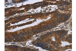 The image on the left is immunohistochemistry of paraffin-embedded Human colon cancer tissue using CSB-PA039047(ARHGEF12 Antibody) at dilution 1/30, on the right is treated with synthetic peptide. (Original magnification: 