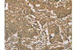 The image on the left is immunohistochemistry of paraffin-embedded Human gastic cancer tissue using CSB-PA039162(EIF6 Antibody) at dilution 1/20, on the right is treated with fusion protein. (Original magnification: 