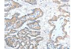 The image on the left is immunohistochemistry of paraffin-embedded Human thyroid cancer tissue using CSB-PA039195(ADAM7 Antibody) at dilution 1/20, on the right is treated with fusion protein. (Original magnification: 