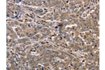 The image on the left is immunohistochemistry of paraffin-embedded Human liver cancer tissue using CSB-PA039309(EDA Antibody) at dilution 1/30, on the right is treated with fusion protein. (Original magnification: 
