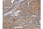The image on the left is immunohistochemistry of paraffin-embedded Human liver cancer tissue using CSB-PA039310(CDC7 Antibody) at dilution 1/70, on the right is treated with synthetic peptide. (Original magnification: 