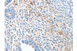 The image on the left is immunohistochemistry of paraffin-embedded Human ovarian cancer tissue using CSB-PA039662(ALDH1A2 Antibody) at dilution 1/60, on the right is treated with synthetic peptide. (Original magnification: 