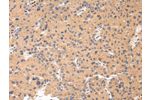The image on the left is immunohistochemistry of paraffin-embedded Human liver cancer tissue using CSB-PA039740(CTSK Antibody) at dilution 1/20, on the right is treated with synthetic peptide. (Original magnification: 
