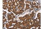 The image on the left is immunohistochemistry of paraffin-embedded Human breast cancer tissue using CSB-PA039805(ASIC1 Antibody) at dilution 1/20, on the right is treated with synthetic peptide. (Original magnification: 