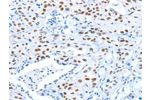 The image on the left is immunohistochemistry of paraffin-embedded Human lung cancer tissue using CSB-PA040400(ARID1A Antibody) at dilution 1/80, on the right is treated with synthetic peptide. (Original magnification: 