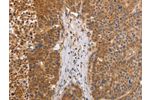 The image on the left is immunohistochemistry of paraffin-embedded Human liver cancer tissue using CSB-PA040512(EGLN3 Antibody) at dilution 1/30, on the right is treated with fusion protein. (Original magnification: 