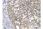 The image on the left is immunohistochemistry of paraffin-embedded Human cervical cancer tissue using CSB-PA040684(DECR1 Antibody) at dilution 1/40, on the right is treated with synthetic peptide. (Original magnification: 