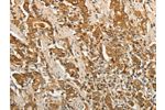 The image on the left is immunohistochemistry of paraffin-embedded Human gastic cancer tissue using CSB-PA040718(F3 Antibody) at dilution 1/25, on the right is treated with fusion protein. (Original magnification: 