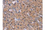 The image on the left is immunohistochemistry of paraffin-embedded Human liver cancer tissue using CSB-PA040869(DVL2 Antibody) at dilution 1/20, on the right is treated with synthetic peptide. (Original magnification: 