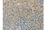 The image on the left is immunohistochemistry of paraffin-embedded Human ovarian cancer tissue using CSB-PA042329(APOA4 Antibody) at dilution 1/30, on the right is treated with fusion protein. (Original magnification: 
