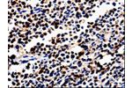 The image is immunohistochemistry of paraffin-embedded Human colon cancer tissue using CSB-PA043268(ALOX5 Antibody) at dilution 1/50. (Original magnification: 
