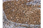 The image on the left is immunohistochemistry of paraffin-embedded Human cervical cancer tissue using CSB-PA043289(CEBPD Antibody) at dilution 1/40, on the right is treated with synthetic peptide. (Original magnification: 