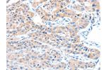 The image on the left is immunohistochemistry of paraffin-embedded Human lung cancer tissue using CSB-PA043425(ADAM32 Antibody) at dilution 1/15, on the right is treated with fusion protein. (Original magnification: 
