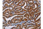 The image on the left is immunohistochemistry of paraffin-embedded Human thyroid cancer tissue using CSB-PA043528(AGPS Antibody) at dilution 1/25, on the right is treated with fusion protein. (Original magnification: 
