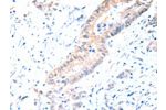 The image on the left is immunohistochemistry of paraffin-embedded Human colon cancer tissue using CSB-PA043583(ACAD10 Antibody) at dilution 1/15, on the right is treated with fusion protein. (Original magnification: 