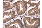 The image on the left is immunohistochemistry of paraffin-embedded Human colon cancer tissue using CSB-PA043697(CRK Antibody) at dilution 1/50, on the right is treated with fusion protein. (Original magnification: 