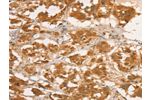 The image on the left is immunohistochemistry of paraffin-embedded Human thyroid cancer tissue using CSB-PA043712(CPB1 Antibody) at dilution 1/50, on the right is treated with fusion protein. (Original magnification: 