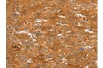The image on the left is immunohistochemistry of paraffin-embedded Human liver cancer tissue using CSB-PA043862(ABCC9 Antibody) at dilution 1/50, on the right is treated with synthetic peptide. (Original magnification: 