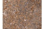 The image on the left is immunohistochemistry of paraffin-embedded Human cervical cancer tissue using CSB-PA043863(APAF1 Antibody) at dilution 1/40, on the right is treated with synthetic peptide. (Original magnification: 