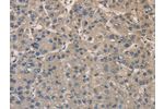 The image on the left is immunohistochemistry of paraffin-embedded Human liver cancer tissue using CSB-PA044503(DPYSL3 Antibody) at dilution 1/20, on the right is treated with fusion protein. (Original magnification: 
