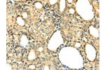 The image on the left is immunohistochemistry of paraffin-embedded Human thyroid cancer tissue using CSB-PA045438(DNASE1 Antibody) at dilution 1/20, on the right is treated with fusion protein. (Original magnification: 