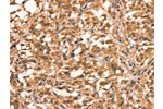 The image on the left is immunohistochemistry of paraffin-embedded Human thyroid cancer tissue using CSB-PA045809(ACADVL Antibody) at dilution 1/15, on the right is treated with synthetic peptide. (Original magnification: 