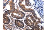 The image on the left is immunohistochemistry of paraffin-embedded Human colon cancer tissue using CSB-PA045919(DNMT3A Antibody) at dilution 1/65, on the right is treated with fusion protein. (Original magnification: 