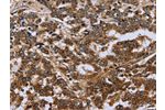 The image on the left is immunohistochemistry of paraffin-embedded Human liver cancer tissue using CSB-PA045962(FH Antibody) at dilution 1/30, on the right is treated with fusion protein. (Original magnification: 