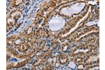 The image on the left is immunohistochemistry of paraffin-embedded Human thyroid cancer tissue using CSB-PA045995(BAG1 Antibody) at dilution 1/40, on the right is treated with fusion protein. (Original magnification: 