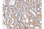 The image on the left is immunohistochemistry of paraffin-embedded Human thyroid cancer tissue using CSB-PA046001(F13A1 Antibody) at dilution 1/80, on the right is treated with synthetic peptide. (Original magnification: 