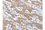 The image on the left is immunohistochemistry of paraffin-embedded Human gastic cancer tissue using CSB-PA046723(DSC1 Antibody) at dilution 1/40, on the right is treated with synthetic peptide. (Original magnification: 