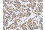 The image on the left is immunohistochemistry of paraffin-embedded Human colon cancer tissue using CSB-PA046947(ECHS1 Antibody) at dilution 1/20, on the right is treated with fusion protein. (Original magnification: 