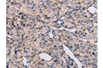 The image on the left is immunohistochemistry of paraffin-embedded Human prostate cancer tissue using CSB-PA047259(EPHA7 Antibody) at dilution 1/20, on the right is treated with synthetic peptide. (Original magnification: 