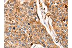 The image on the left is immunohistochemistry of paraffin-embedded Human esophagus cancer tissue using CSB-PA047604(CTSB Antibody) at dilution 1/140, on the right is treated with fusion protein. (Original magnification: 