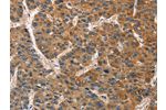 The image on the left is immunohistochemistry of paraffin-embedded Human liver cancer tissue using CSB-PA047722(BRE Antibody) at dilution 1/40, on the right is treated with fusion protein. (Original magnification: 