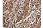 The image on the left is immunohistochemistry of paraffin-embedded Human gastic cancer tissue using CSB-PA047746(COX6B1 Antibody) at dilution 1/50, on the right is treated with fusion protein. (Original magnification: 