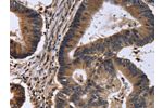 The image is immunohistochemistry of paraffin-embedded Human colon cancer tissue using CSB-PA048430(FSTL1 Antibody) at dilution 1/30. (Original magnification: 