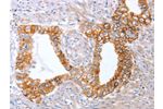 The image on the left is immunohistochemistry of paraffin-embedded Human cervical cancer tissue using CSB-PA048521(ABO Antibody) at dilution 1/50, on the right is treated with synthetic peptide. (Original magnification: 
