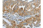 The image on the left is immunohistochemistry of paraffin-embedded Human ovarian cancer tissue using CSB-PA048817(DNAJC10 Antibody) at dilution 1/20, on the right is treated with fusion protein. (Original magnification: 