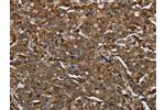 The image on the left is immunohistochemistry of paraffin-embedded Human liver cancer tissue using CSB-PA048999(ARHGDIA Antibody) at dilution 1/30, on the right is treated with fusion protein. (Original magnification: 