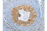 The image on the left is immunohistochemistry of paraffin-embedded Human cervical cancer tissue using CSB-PA049170(DGKZ Antibody) at dilution 1/60, on the right is treated with synthetic peptide. (Original magnification: 
