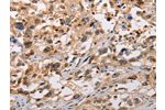The image on the left is immunohistochemistry of paraffin-embedded Human esophagus cancer tissue using CSB-PA049233(ADAMDEC1 Antibody) at dilution 1/20, on the right is treated with fusion protein. (Original magnification: 