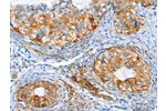 The image on the left is immunohistochemistry of paraffin-embedded Human cervical cancer tissue using CSB-PA049334(AIP Antibody) at dilution 1/80, on the right is treated with synthetic peptide. (Original magnification: 