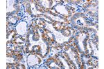 The image on the left is immunohistochemistry of paraffin-embedded Human thyroid cancer tissue using CSB-PA049381(FHIT Antibody) at dilution 1/25, on the right is treated with fusion protein. (Original magnification: 